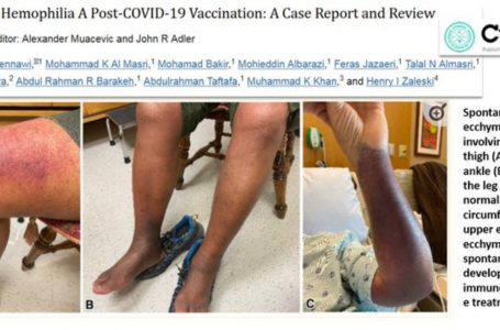 “Emofilia acquisita da vaccinazione post-COVID-19”: un caso clinico e revisione