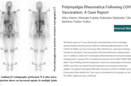 Polimialgia reumatica dopo la vaccinazione COVID-19: un caso clinico