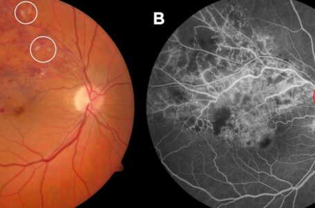 Aumento del 20.000% dei danni oculari alla retina dopo la vaccinazione contro il COVID-19